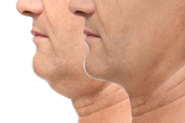HIFU - Breakthrough in Anti - ageing 2 hifu results East Kilbride