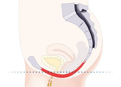 Pelvic-Floor Muscle Repair 5 Pelvic floor muscles East Kilbride