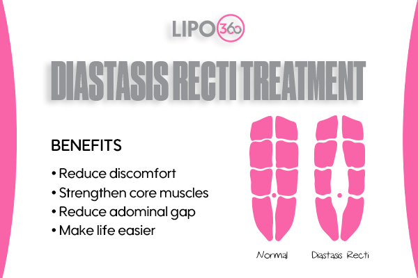 Revolutionising Muscle Repair: The Power of LIPO360 Body Sculpt Post-Injury 5 diastasis recti treatment East Kilbride