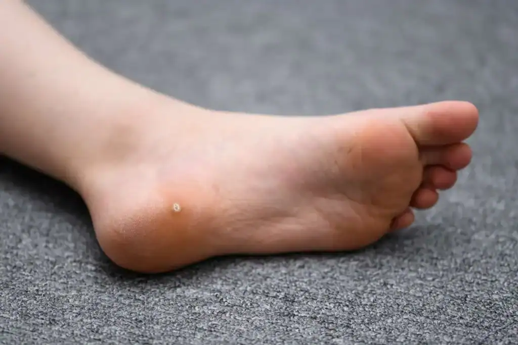 Cryotherapy For Warts And Also Verrucas 2 Image of verruca on the bottom of the foot that able to be treated with Cryotherapy East Kilbride