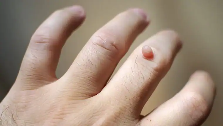 Cryotherapy For Warts And Also Verrucas 1 Image of blemish that Cryotherapy East Kilbride can remove with Lipo 360.