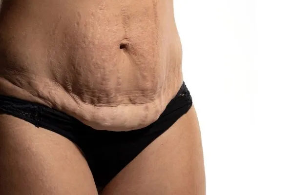 The Science of Skin Tightening 1 The science behind skin tightening East Kilbride picture of a woman's sagging skin on the stomach